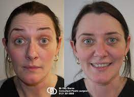 Jan 27, 2020 · in general, you can see the effects of botox as early as 3 to 4 days after an injection. Botox