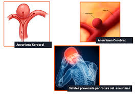 A brain aneurysm, also known as a subarachnoid hemorrhage (sah), is a weak spot in the wall of a blood vessel inside the brain. Aneurismas Cerebrales Neurotorche