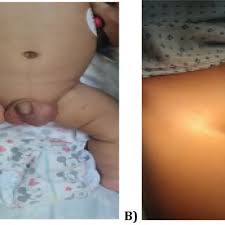Image result for Inguinal hernia child