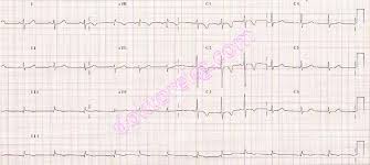 Image result for Q Wave