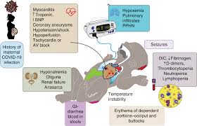 Image result for Multisystem Inflammatory Syndrome