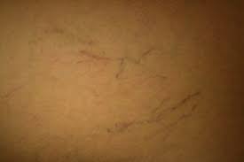 What are the side effects of laser hair removal? Laser Treatments The Plastic Surgery Group