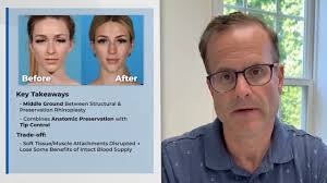 In this video, Dr. Derek Steinbacher discusses, “Refining Patient Selection  in Hybrid Dorsal Preservation Rhinoplasty: A Review of 50 Patients,” by  Kumar, Sherif, and Rohrich, which appears in the ...