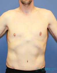 Plastic Surgery After Massive Weight Loss Salt Lake City Layton Utah