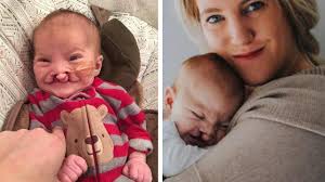 Questo bambino viene considerato un po' bruttino a causa della sua  malformazione, eccolo oggi dopo 7 anni