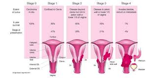 Pencegahan dini merupakan solusi awal untuk anda mengatasi keputihan. Ulasan Seputar Penyebab Gejala Awal Kanker Serviks Dan Penanganannya