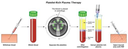 The Biological Process of PRP Therapy, AI generated