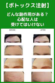 シワ取りボトックス 都市伝説 肌荒れ ニキビ 美容 治療