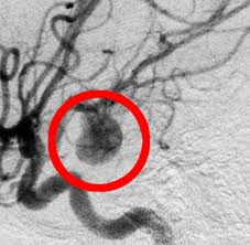 Aneurysma Den Gerauschlosen Killer Spurt Der Mensch Nicht Welt