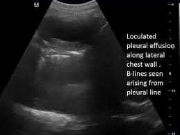 Most pleural effusions, whether free flowing or loculated, are hypoechoic with a sharp echogenic line that delineates the visceral pleura and lung. Case 494 Lung Ultrasound Posterolateral Pleural Effusion With Bilateral Loculated Pleural Effusion Youtube