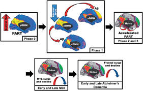 Image result for alzheimer 1981 2021