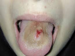 Maybe you would like to learn more about one of these? Is It Dangerous To Get Your Tongue Pierced Quora
