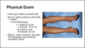 Image result for Edema Exam