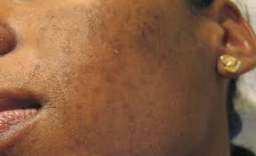 Le bain vapeur, appelé aussi fumigation (ou sauna facial), est l'utilisation de la vapeur pour dilater les pores du visage et faciliter l'extraction des impuretés. Le Sauna Facial Le Geste Beaute Maison Pour Une Peau Lumineuse Setalmaa