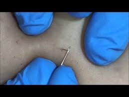 I have a huge ingrown hair | d.i.y ingrown hair/razor bump treatment for beards. How To Remove Ingrown Hairs Pre Electrolysis Care Youtube Ingrown Hair Removal Ingrown Hair How To Remove