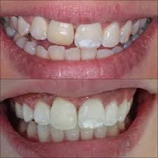 The resin will fill in the missing areas or replace a corner that has broken off. Cosmetic Tooth Bonding Exeter The Whyte House Dental Practice