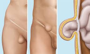 Also bei mir wurde links und rechts ein leistenbruch festgestellt. Leistenbruch Leistenhernie Ursache Diagnose Und Behandlung Ksw