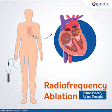 Image result for Radiofrequency Surgery