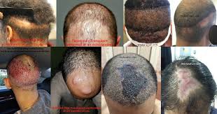 The average cost of beard hair transplant in dubai, abu dhabi is lower than this. How A Cheap Transplant Will Cost More In The Long Run