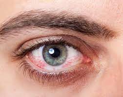 Geplatzte Ader Im Auge Besteht Gefahr