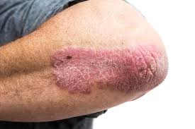 The person's breathing becomes irregular and may become noisy. Psoriasis And Cancer What S The Link Harvard Health