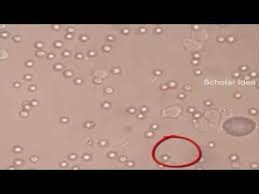 Hematouria Pyuria And Urate Crystals In Urine Urinal Crystals Celestial Bodies