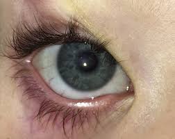 Lyme Disease Presenting As Persistent Severe Photophobia Journal Of American Association For Pediatric Ophthalmology And Strabismus Jaapos
