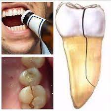 لا تفعل ذلك العناية بالفم والأسنان Dental Implants Cost Dental Videos Dentistry
