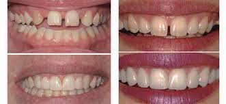 Our members are our number one priority. How To Find Cosmetic Dentistry Near Me And Is It Worth It Broadway Family Dental Care