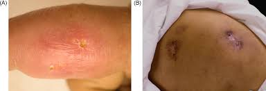 They'll inject a tiny amount of fluid called tuberculin just below the skin in. Primary Mycobacterium Tuberculosis Complex Cutaneous Infection Report Of Two Cases And Literature Review International Journal Of Infectious Diseases