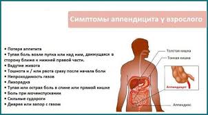 Kak Opredelit Appendicit Appendicitis V Domashnih Usloviyah Simptomy I Pervye Priznaki Vospaleniya Cherveobraznogo Otrostka Slepoj Kishki U Vzroslyh I Detej
