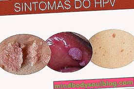 Human papillomavirus (hpv) is the most common viral infection of the reproductive tract. Ù‚Ø¯ ÙŠÙƒÙˆÙ† Ù…Ø±Ù‡Ù… Barbatimao Ù‡Ùˆ Ø§Ù„Ø¹Ù„Ø§Ø¬ Ù„ÙÙŠØ±ÙˆØ³ Ø§Ù„ÙˆØ±Ù… Ø§Ù„Ø­Ù„ÙŠÙ…ÙŠ Ø§Ù„Ø¨Ø´Ø±ÙŠ