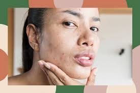 While hydrocolloid pimple patches are relatively new, hydrocolloid bandages have been used in medical. The Truth About How Those Trendy Acne Patches Really Work According To Dermatologists Hellogiggles