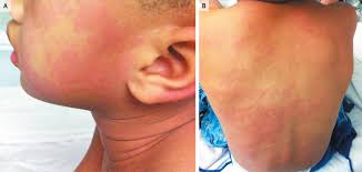 Image result for Scombroid Fish Poisoning