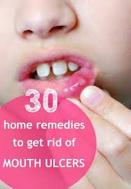 30 Home Remedies For Treating Mouth Ulcers Ulcer Remedies Mouth Treating Mouth Ulcers Mouth Ulcers