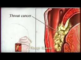 Stomach cancer is a cancer that's found anywhere in the stomach. Throat Cancer Symptoms In Tamil Language Celine Dion Songs Age