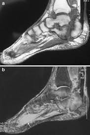 It is considered the most common cause of heel pain. Mri Appearance Of Muscle Denervation Springerlink