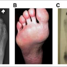 Young female cross-country runner who presented with 1 month of left...