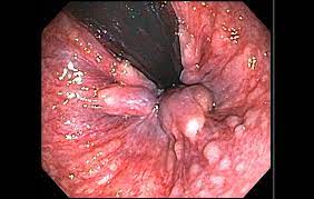They rarely cause any pain, as this tissue doesn't have any sensory nerves. 11 Things Every Woman Needs To Know About Hemorrhoids Prevention