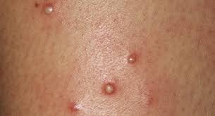 The extract can be applied on the infected area by soaking it into a. Pus Boils In Babies And Toddlers Babycenter India