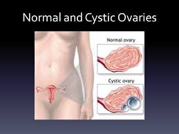Ovarian cancer is the uncontrolled growth of abnormal cells in the ovaries. Ovarian Cysts Kasey Durham What Are Ovarian Cysts The Mayo Clinic Defines Ovarian Cysts As Fluid Filled Sacs Or Pockets Located Within Or On The Ovary Ppt Download