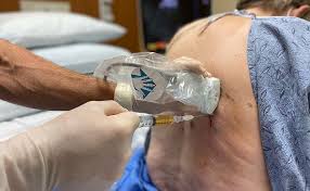 Image result for Thoracentesis