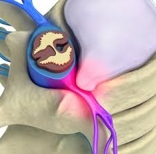 Maybe you would like to learn more about one of these? Herniated Disc Discover Symptoms And Find The Right Treatments Pain Relief Institute