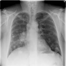 In contrast, after disease has spread widely throughout the body, the prostate is less likely to be the source of metastases. Pulmonary Metastases Radiology Reference Article Radiopaedia Org