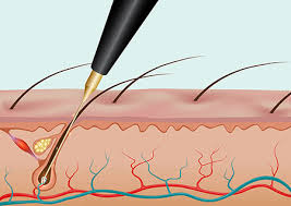 While many women deal with some type of facial hair on a regular basis, ranging from light, barely noticeable electrolysis is the only form of permanent hair removal currently approved by the fda. Electrolysis Bald