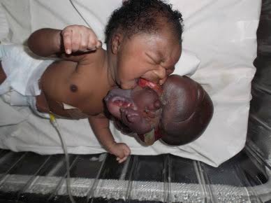 Mga resulta ng larawan para sa Fetus in Fetu Twins in a child"