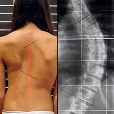 Learn back anatomy faster with our online flashcards. Low Back Pain Lumbar Spine Pain Causes Symptoms Treatment Diagnosis