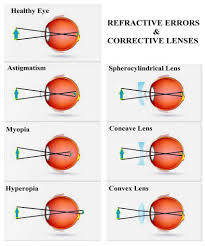Image result for Refractive Error
