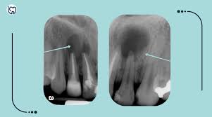 Image result for Periapical Block