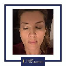 No filter needed after my BioRepeel treatment 💙💙💙